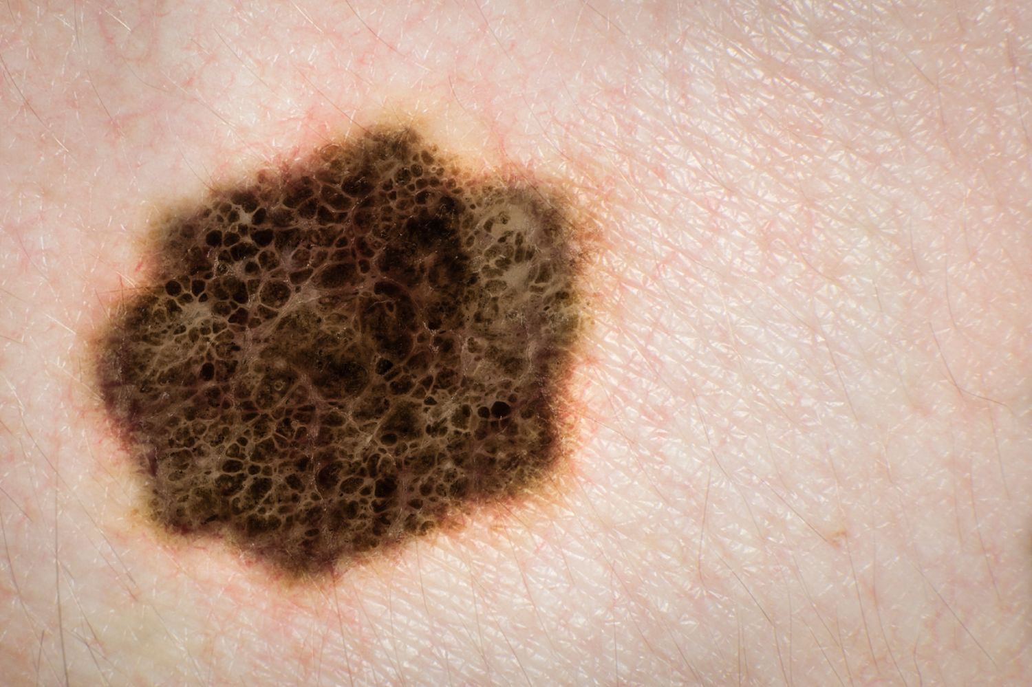 http://www.lifeline.de/img/dermatitis/origs140450/6699478000-w1500-h1500/Malignes-Melanom.jpg