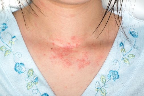 Rash around the neck. - Dermatology - MedHelp