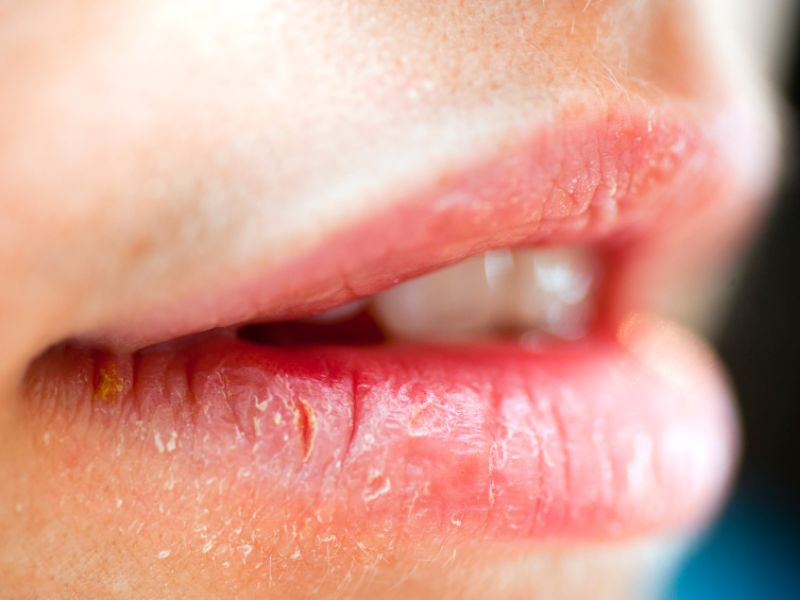 Flüssigkeitsmangel: Spröde Lippen sind Symptom