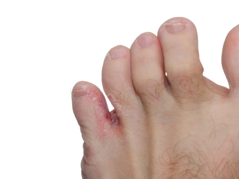 An sich können sich Hautpilze wie die Dermatophyten über jede Stelle des Fußes "hermachen". Typischerweise befallen sie aber zunächst die feuchten und wärmeren Zehenzwischenräume, und hier besonders die beiden Zwischenräume "außen" an den Füßen, also zwischen kleiner Zehe und vierter Zehe sowie zwischen dritter und vierter Zehe. Fußpilz zwischen den Zehen