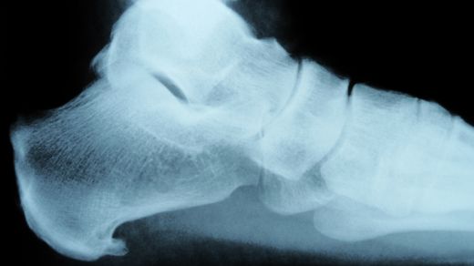 X-ray image of heel spur