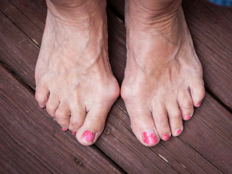Hallux valgus verursacht Fußschmerzen