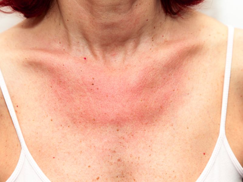 Sonnenallergie homöopathisch behandeln