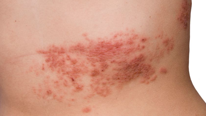 Gürtelrose: Symptome, Behandlung und Ursache von Herpes Zoster