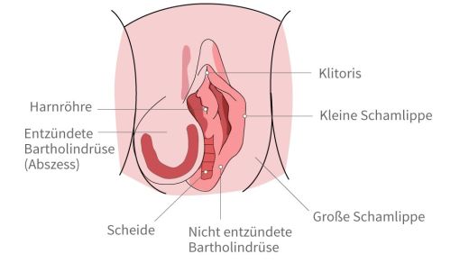 Bartholinitis • Behandlung je nach Schwere