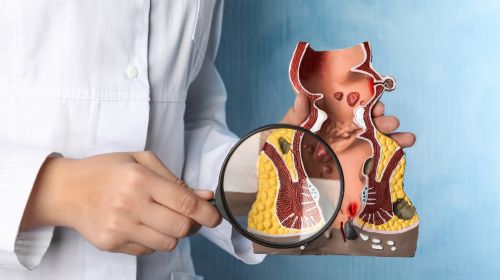 12 enfermedades anales comunes y sus causas
