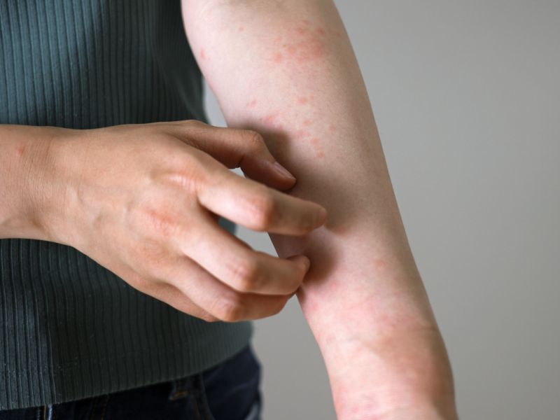 Allergische Reaktion bei Bettwanzen-Bissen