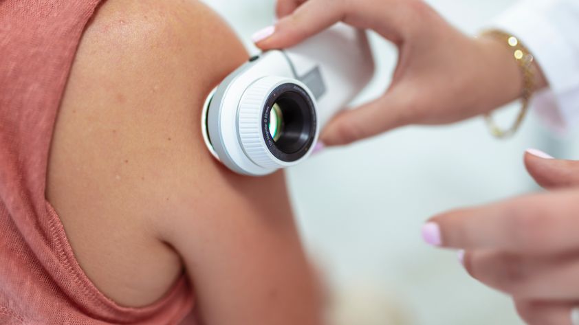 Hautkrebs: Symptome, Ursachen und Behandlung