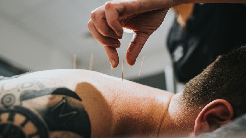 Akupunktur: So wirken und helfen die Nadeln