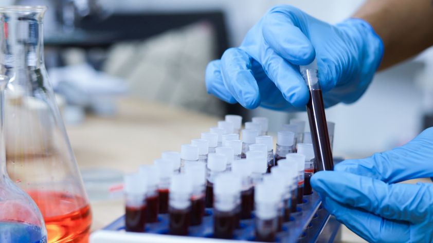 Triglyceride: Was bedeutet der Wert?
