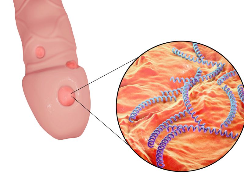 Primäre Syphilis: Geschwür ist erstes Symptom