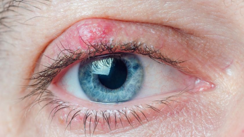 Was ist ein Hagelkorn am Auge und wie lässt es sich entfernen?