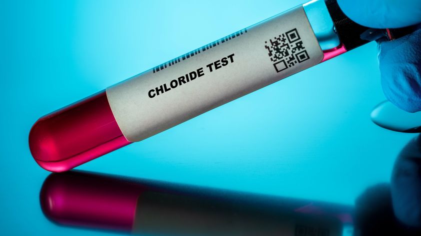 Chlorid im Blut: Ursachen für erhöhten oder niedrigen Wert