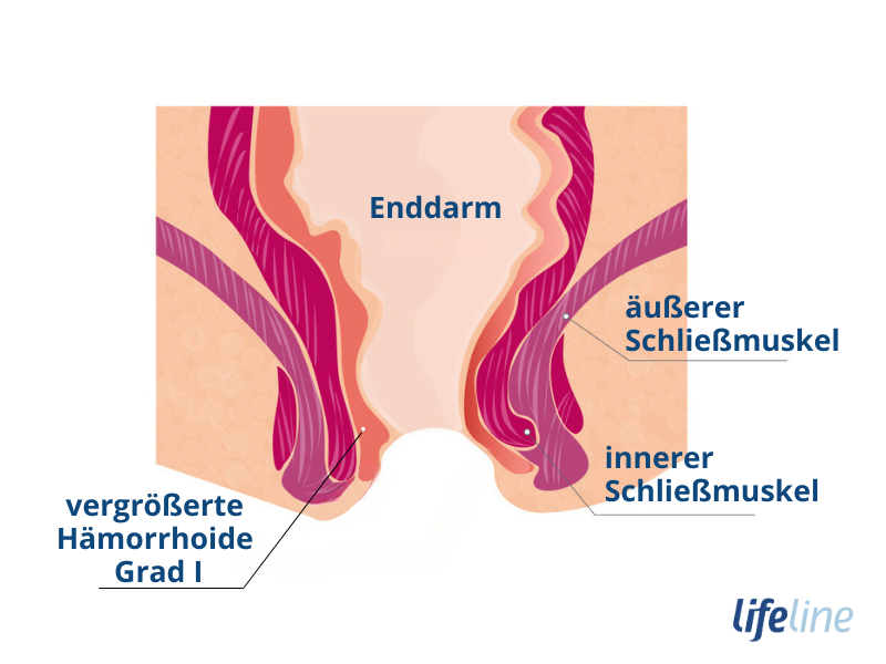 Bild von vergrößerter Hämorrhoide Grad 1