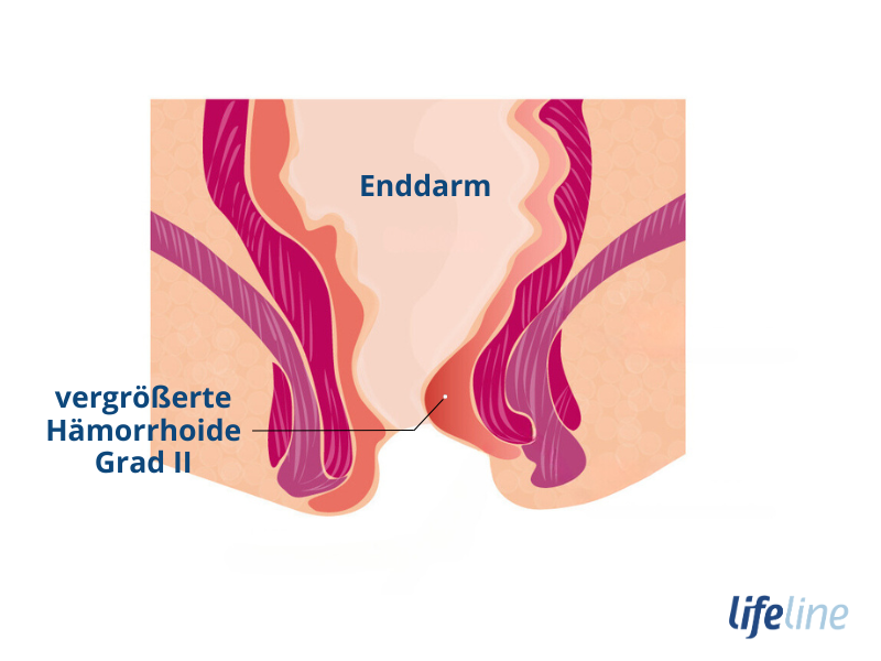 Aussehen von Hämorrhoiden Grad 2