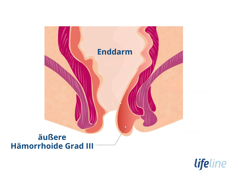 Wie sehen Hämorrhoiden Grad 3 aus?