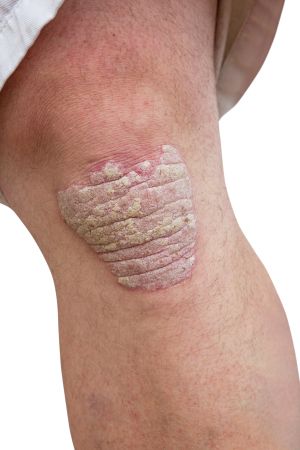 Psoriasis am Knie