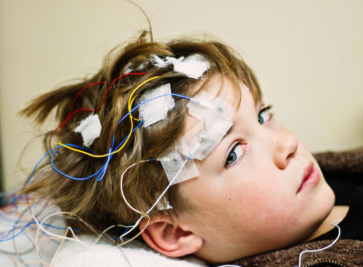 Epilepsie • Symptome & Ursachen epileptischer Anfälle