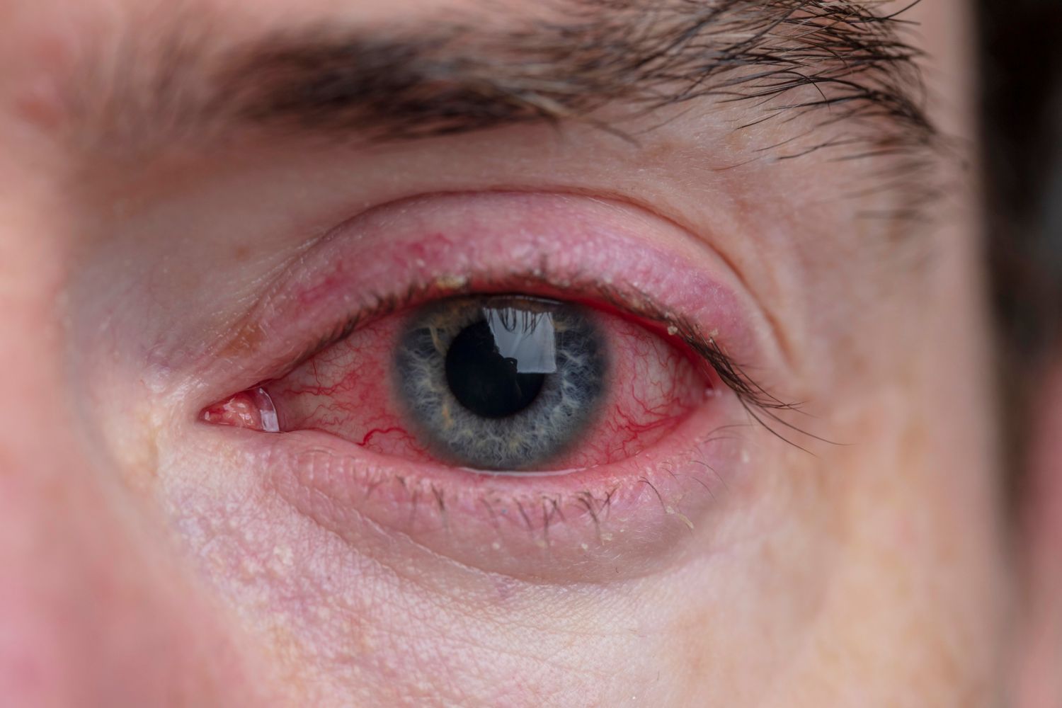 Augengrippe-Hochansteckende-Infektion-mit-Adenoviren