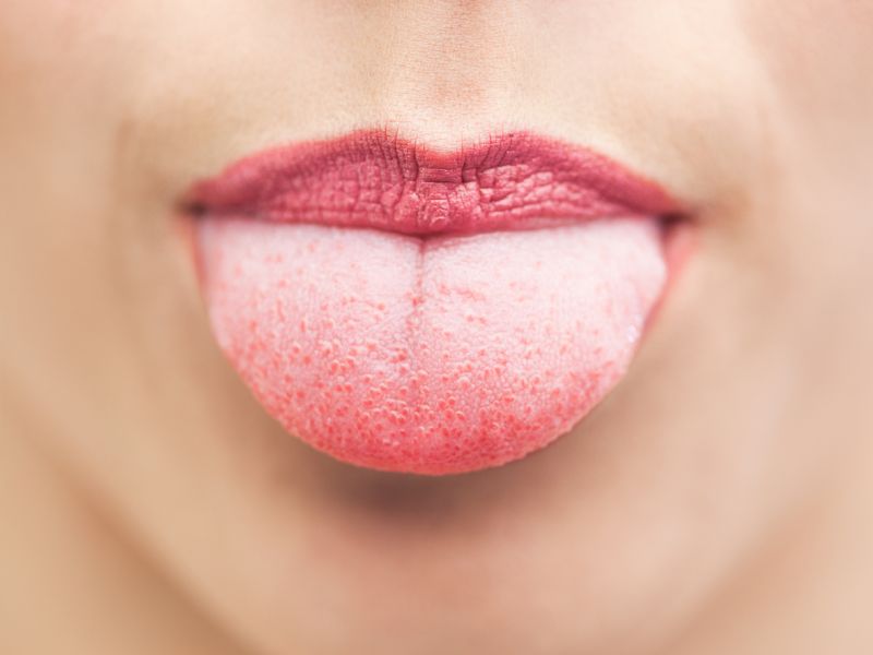 Lippen ablecken fördert eingerissene Mundwinkel