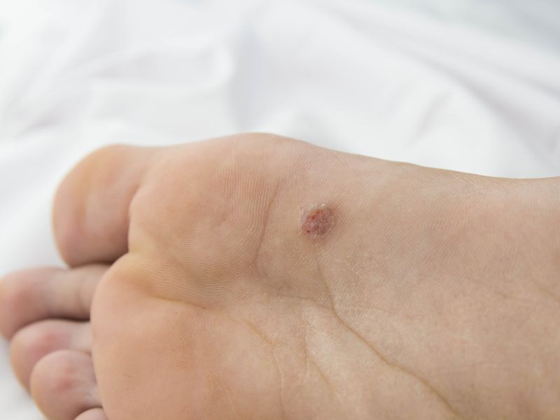 Dornwarzen entstehen fast immer an den Fußsohlen. Weil sie dort starkem Druck ausgesetzt sind, wachsen Dornwarzen im Gegensatz zu anderen Warzenformen nach innen in die Tiefe. Das macht die Behandlung vergleichsweise langwierig. Dornwarzen auf der Fußsohle