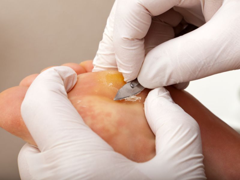Als Standard-Therapie bei Dornwarzen gilt die Keratolyse. Dabei wird die zuvor durch eine säurehaltige Tinktur aufgeweichte, nicht durchblutete obere Hornschicht abgetragen (zum Beispiel mit einem Hornhauthobel, Drogerie). Vorsicht: Diabetiker sollten sich dazu in die Hände eines Spezialisten begeben; der Arzt schabt die Hornhaut mit einem Skalpell ab. Hornhaut-Abtrag bei Keratolyse