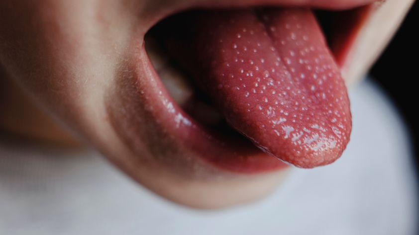 Zungendiagnose: Symptome und Warnzeichen im Mund