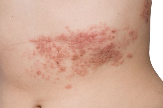 Picture of shingles on the skin