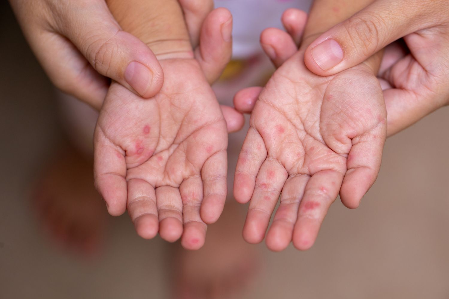 HandFußMundKrankheit Symptome bei Kindern und Erwachsenen
