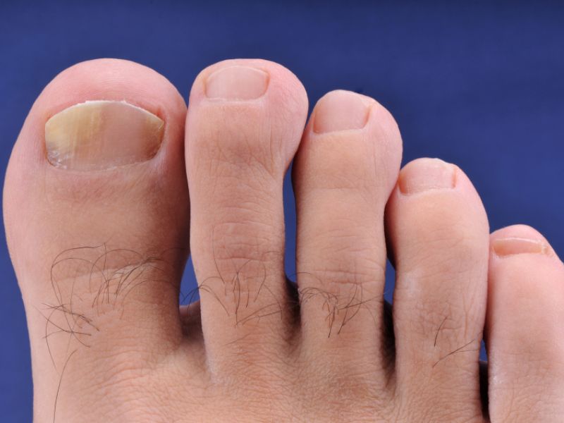 Nagelpilz