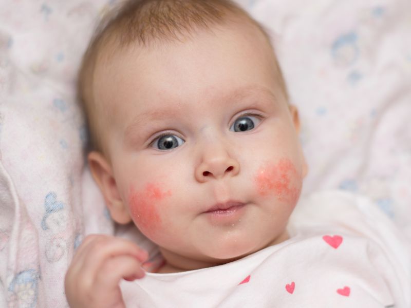 Neurodermitis in Bildern: Bei Babys beginnt es im Gesicht