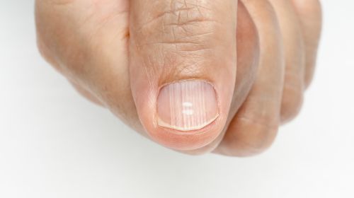 Reconocer las enfermedades de las uñas: qué surcos longitudinales y co.  significar