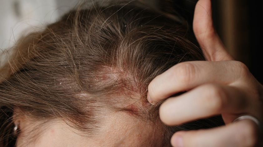 Schuppenflechte auf der Kopfhaut: Ursachen und was hilft
