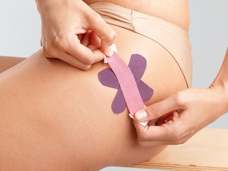 Kleine Bereiche können sternförmig mit mehreren Streifen des Kinesio Tapes beklebt werden. Anwendbar bei punktuellen Schmerzen, zum Beispiel bei kleinen Hämatomen oder Hexenschuss. Einzelne Schmerzpunkte
