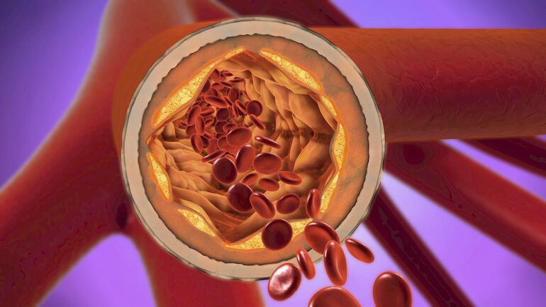 Arteriosklerose: Was steckt hinter der Gefäßverkalkung