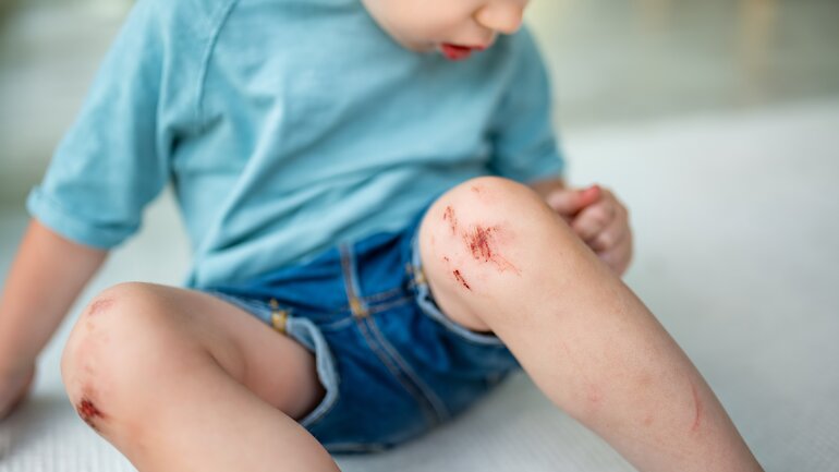 Kind hat Schürfwunden am Knie