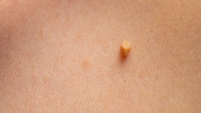 Fibrom nie selbst entfernen
