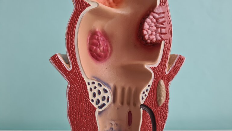 Analthrombose: Blutgerinnsel am After