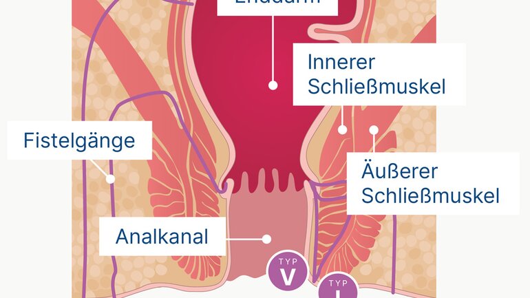 Analfistel: Oft Folge von Analabszess