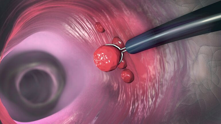 Analfibrom: Gutartige Analerkrankung