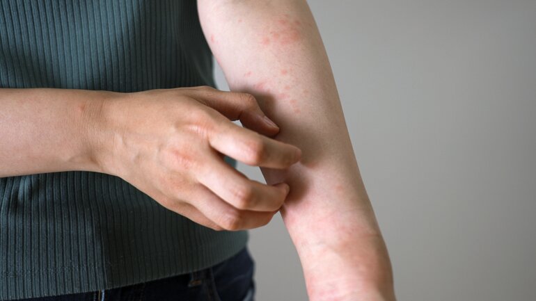 Allergische Reaktion bei Bettwanzen-Bissen