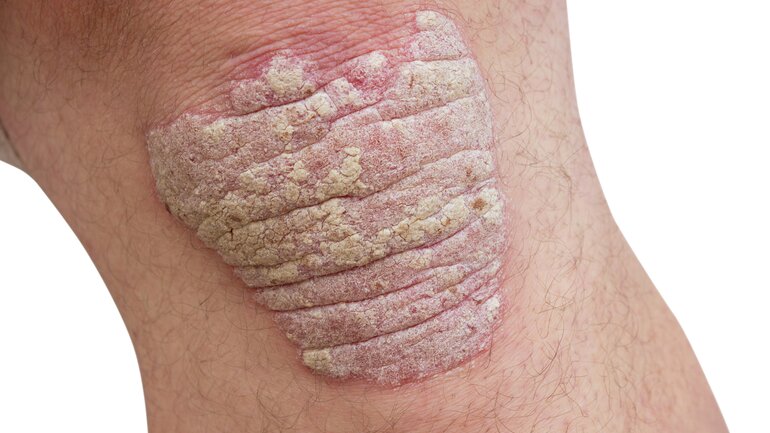 Psoriasis am Knie
