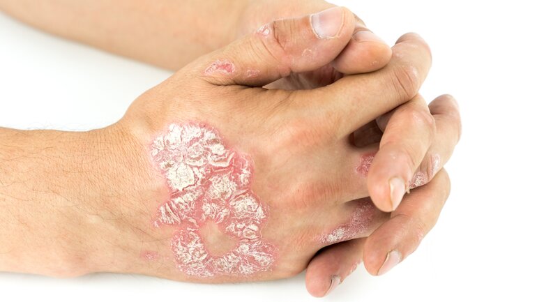 Psoriasis an den Händen