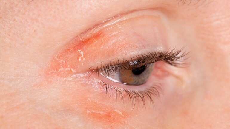 Psoriasis am Auge