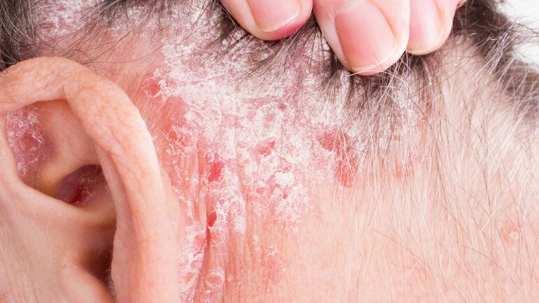 Kopfhautpsoriasis: Schuppenflechte am Kopf