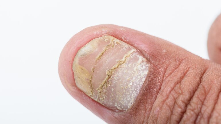 Nagelpsoriasis
