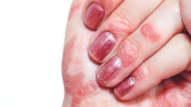 Nagelpsoriasis