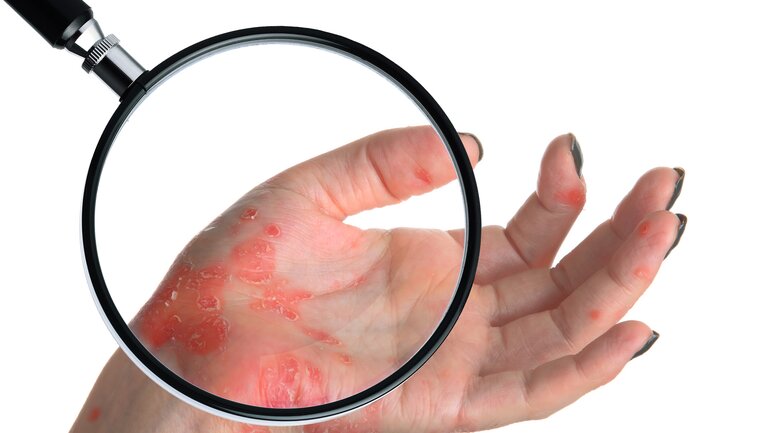 Psoriasis pustulosa palmoplantaris
