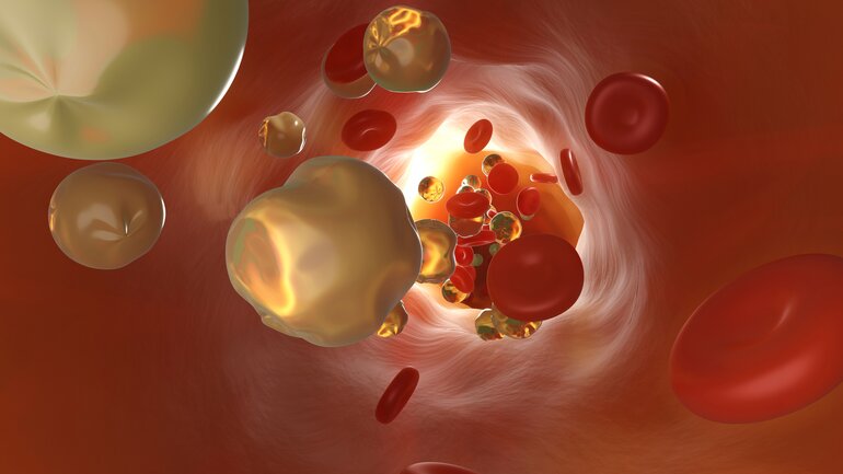 Blutfettwerte: Hohe Fettwerte im Blut?