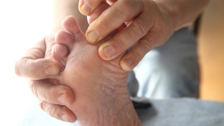 Durchblutungsstörungen sind die Ursache für das diabetische Fußsyndrom